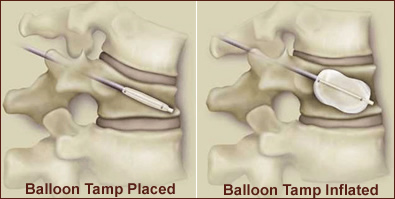 Kyphoplasty procedure offered at Artery and Vein Specialists of Idaho in Blackfoot and Pocatello