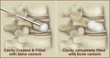 Kyphoplasty procedure offered at Artery and Vein Specialists of Idaho in Blackfoot and Pocatello